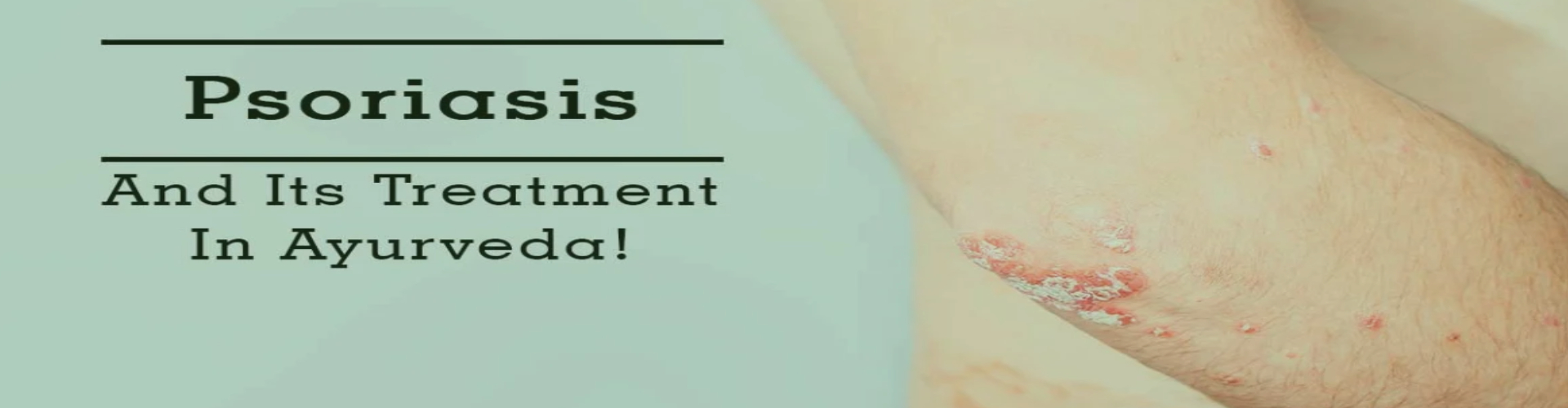 Psoriasis Ayurveda Treatment