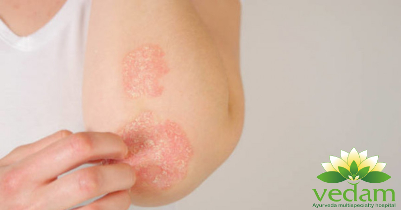 Ayurvedic Tips for Psoriasis Relief