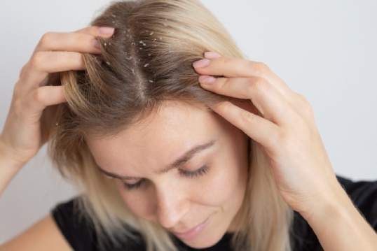 scalp psoriasis treatment | scalp psoriasis cure In Bangalore