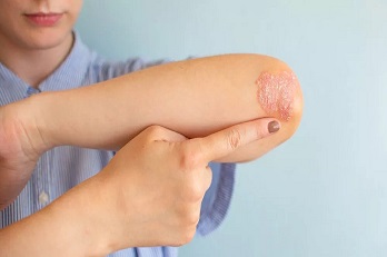 How We Can Help You Treat Your Skin Psoriasis