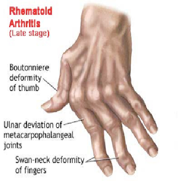Premium arthritis treatment in bangalore