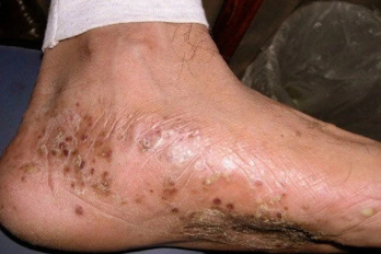 ayurvedic eczema treatment