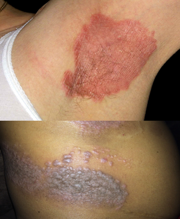 top skin psoriasis ayurvedic treatment