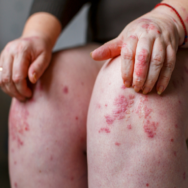 best doctor for psoriasis in bangalore