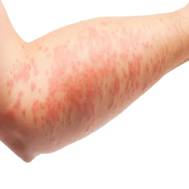 skin eczema ayurvedic treatment in Bangalore