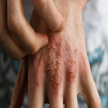 Ayurvedic cure for eczema