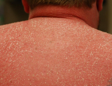 psoriasis ayurvedic treatment