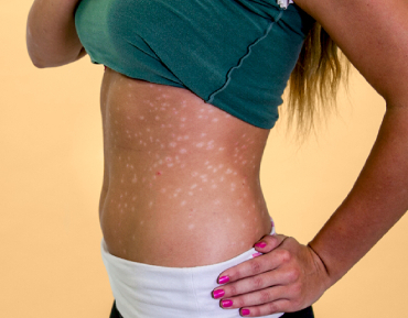 psoriasis ayurvedic treatment