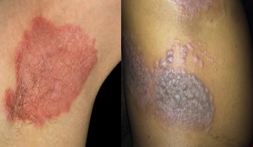 psoriasis ayurvedic treatment