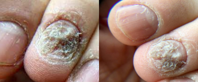 psoriasis ayurvedic treatment