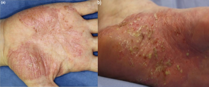 psoriasis ayurvedic treatment