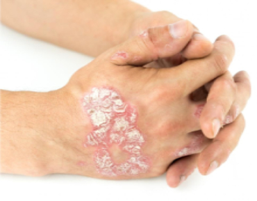 psoriasis ayurvedic treatment