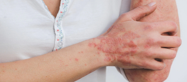 psoriasis ayurvedic treatment