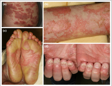 psoriasis ayurvedic treatment