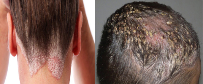 psoriasis ayurvedic treatment