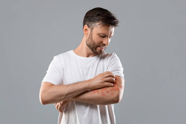 Eczema Care