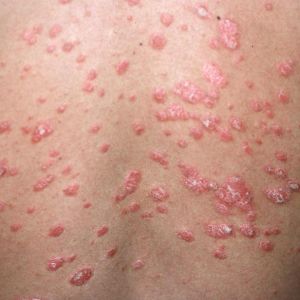 Guttate Psoriasis