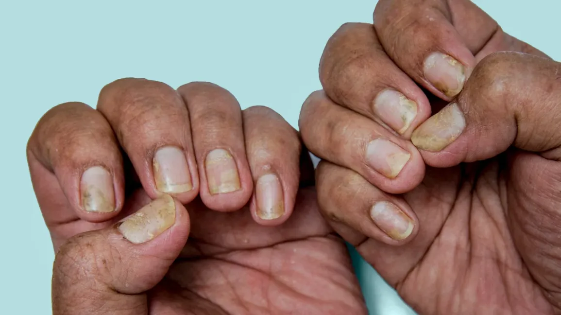 Nail Psoriasis