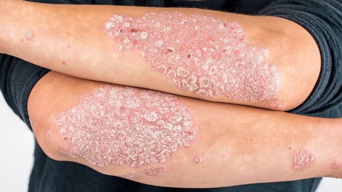 Plaque Psoriasis