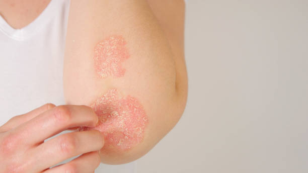 Psoriasis Treatment