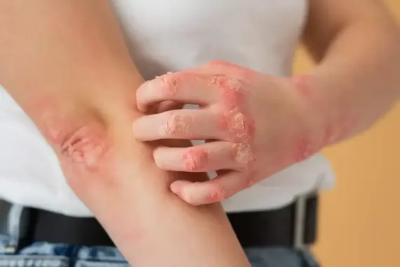 Ayurvedic Treatment of Psoriasis in Bangalore