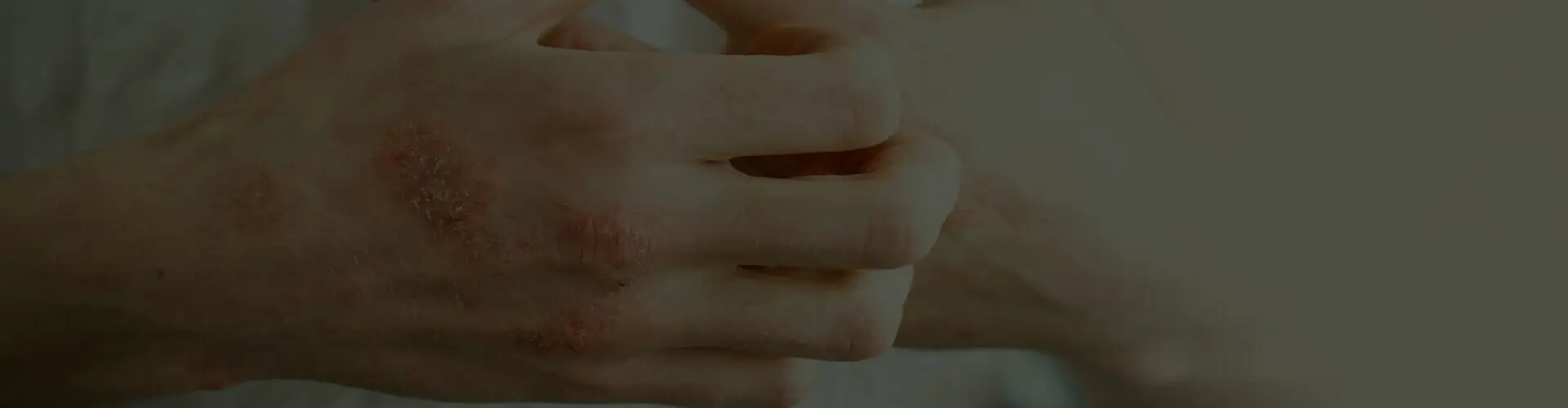 Ayurvedic Treatment For Eczema