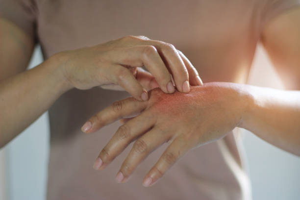 Best Ayurvedic Treatment of Eczema in Bangalore