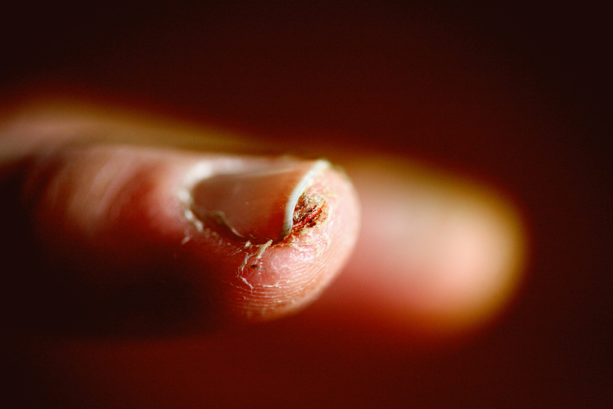 Ayurvedic Treatment for Nail Psoriasis