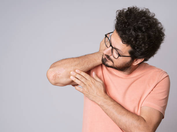 Ayurvedic Treatment for Plaque Psoriasis