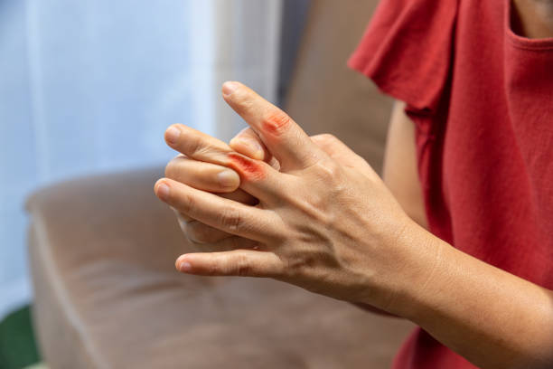 Rheumatoid Arthritis Treatment