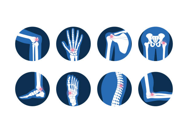 Joint Arthritis Treatment