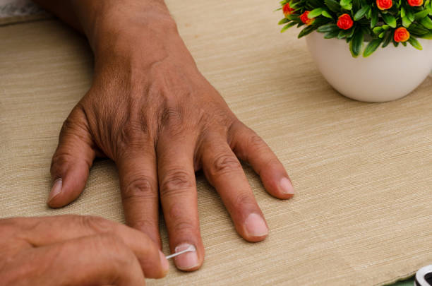 Ayurvedic Treatment for Nail Psoriasis