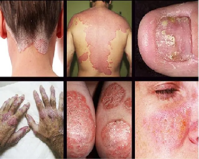 Best Psoriasis Ayurvedic Treatment