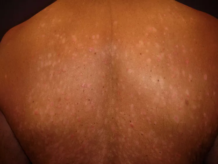 Guttate Psoriasis