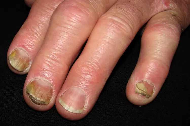 Nail Psoriasis