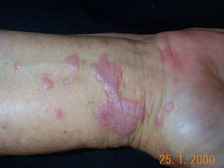 Plaque Psoriasis